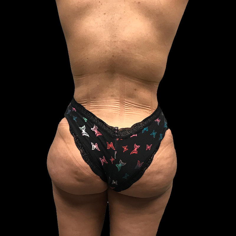 Brazilian Butt Lift 40
