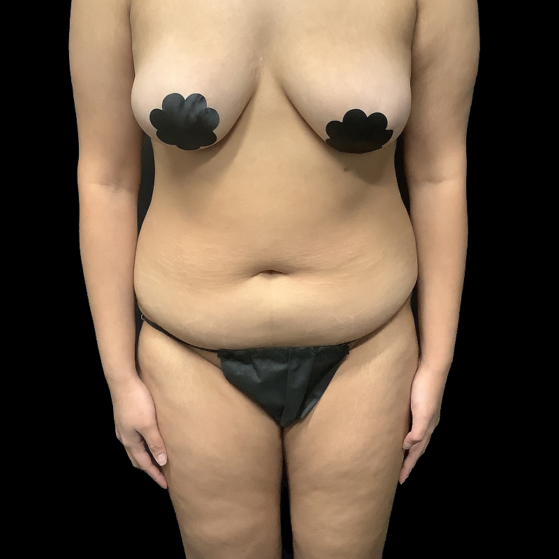 Brazilian Butt Lift 03