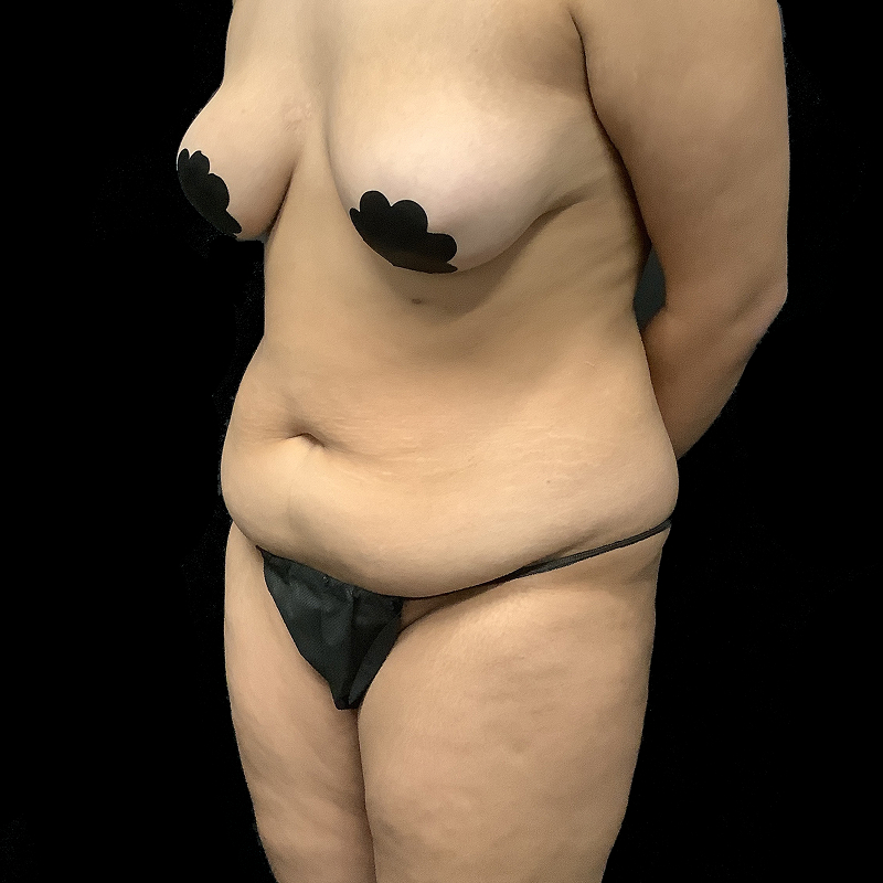 Brazilian Butt Lift 05