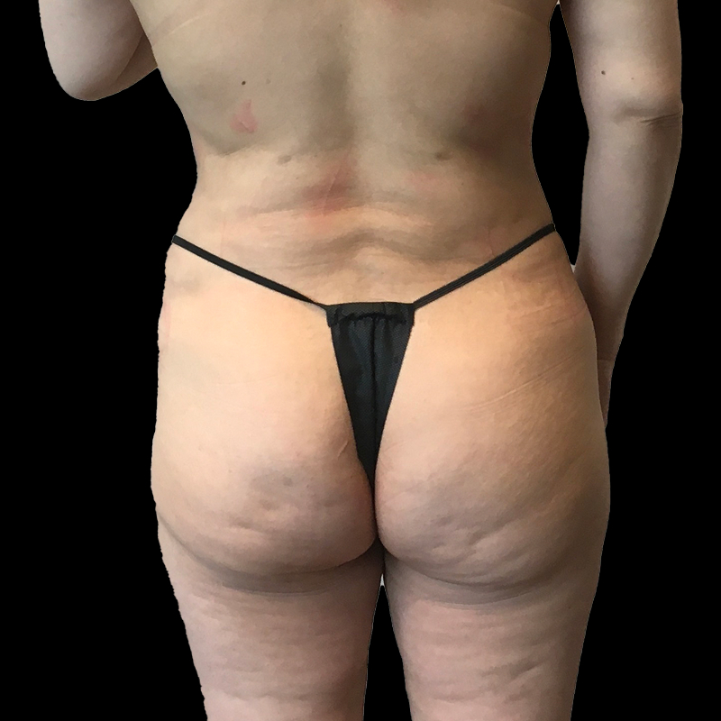 Brazilian Butt Lift 42