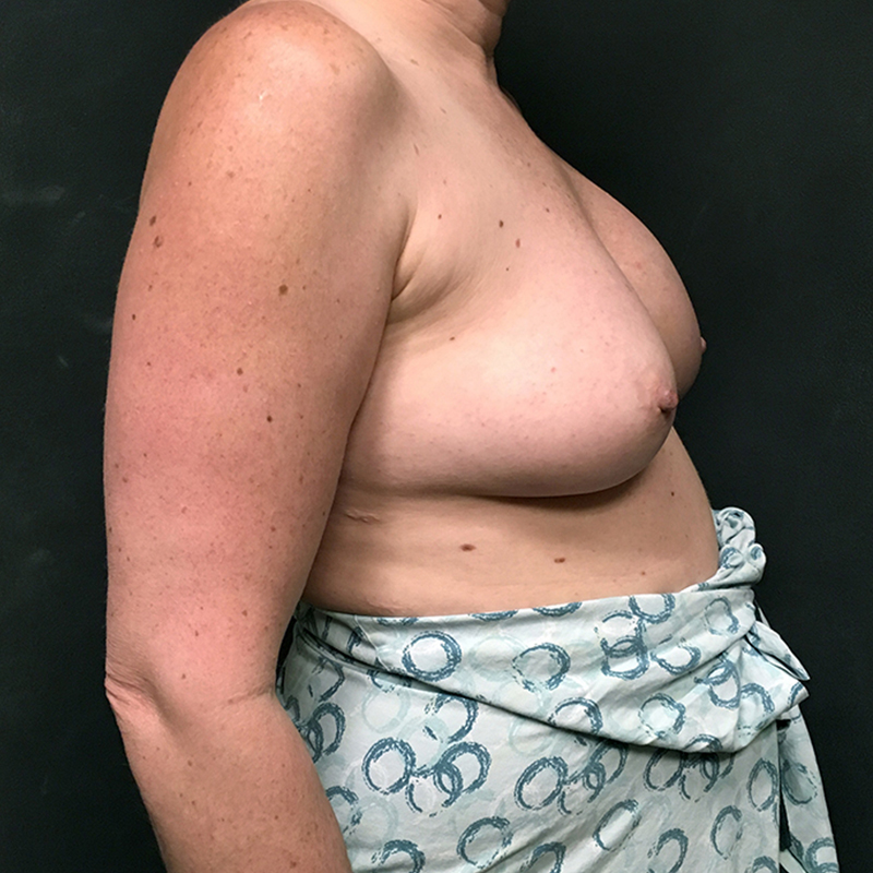 Breast Augmentation Revision 07