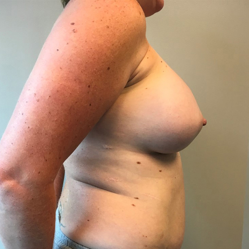 Breast Augmentation Revision 07