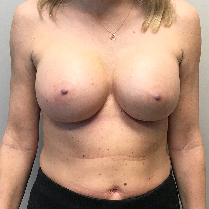 Breast Augmentation Revision 08