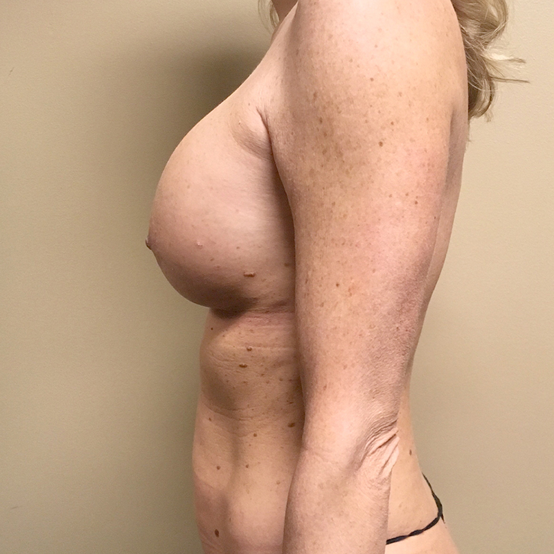 Breast Augmentation Revision 03