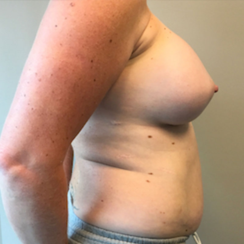 Breast Augmentation Revision 09