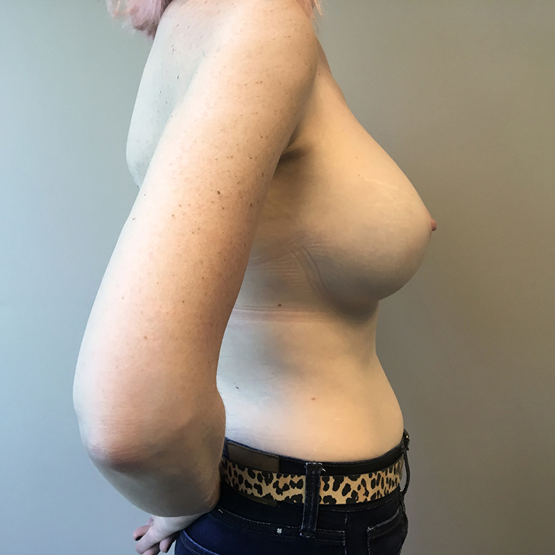 Breast Augmentation Revision 07