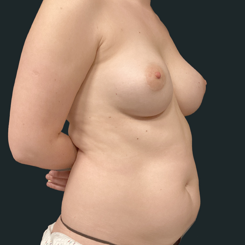 Breast Augmentation Revision 01