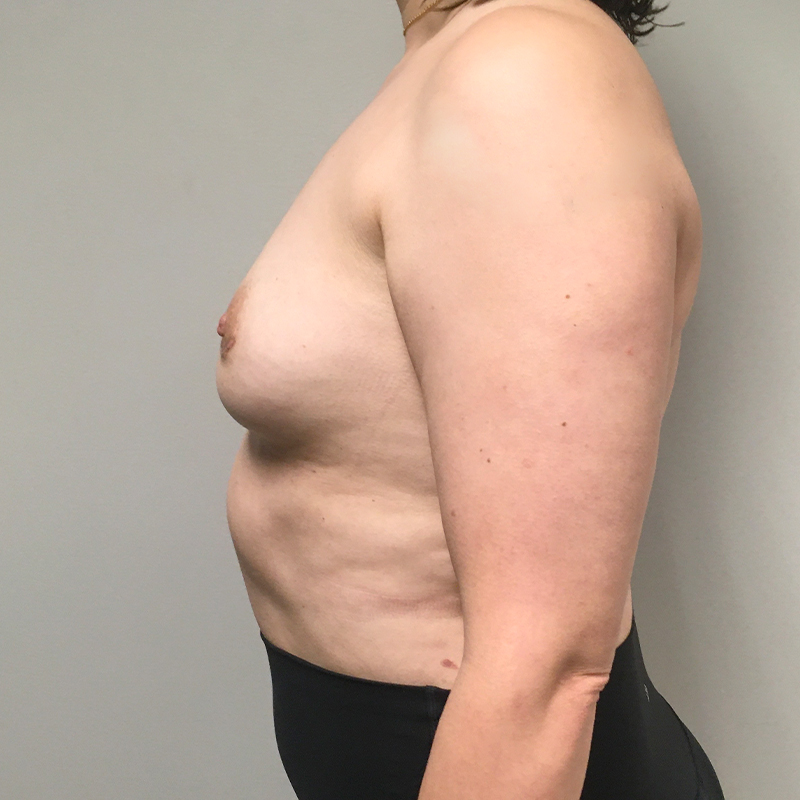 Breast Augmentation Revision 07