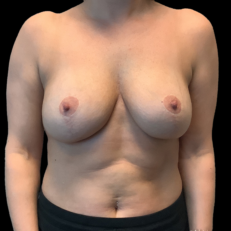 Breast Augmentation Revision 18
