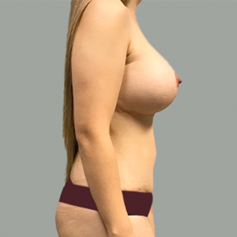 Breast Augmentation With Lift 05