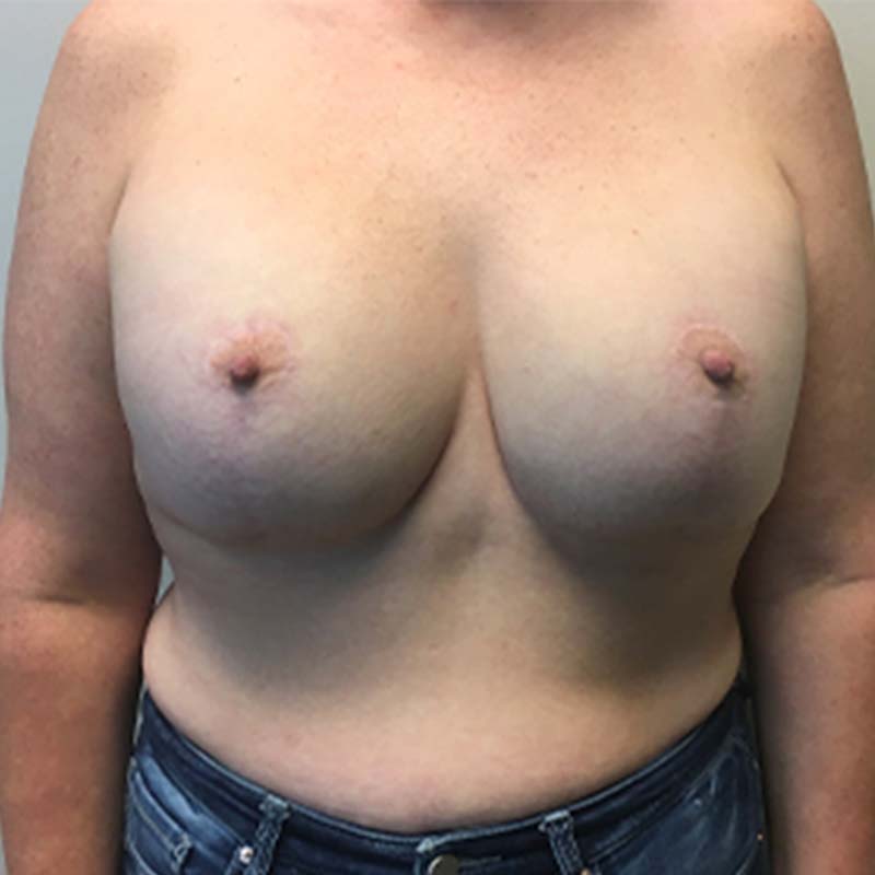 Breast Augmentation With Lift 03