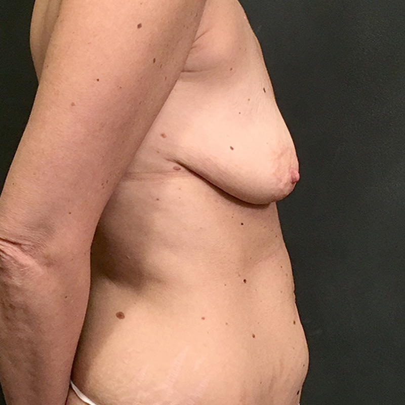 Breast Augmentation With Lift 07