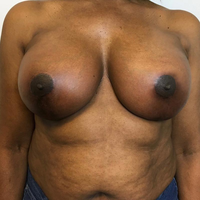 Breast Augmentation With Lift 05