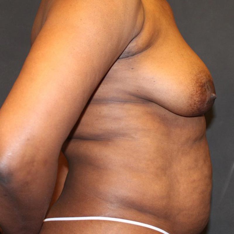 Breast Augmentation With Lift 09