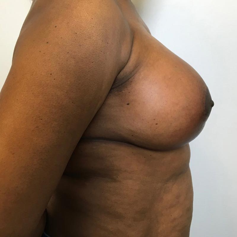Breast Augmentation With Lift 09