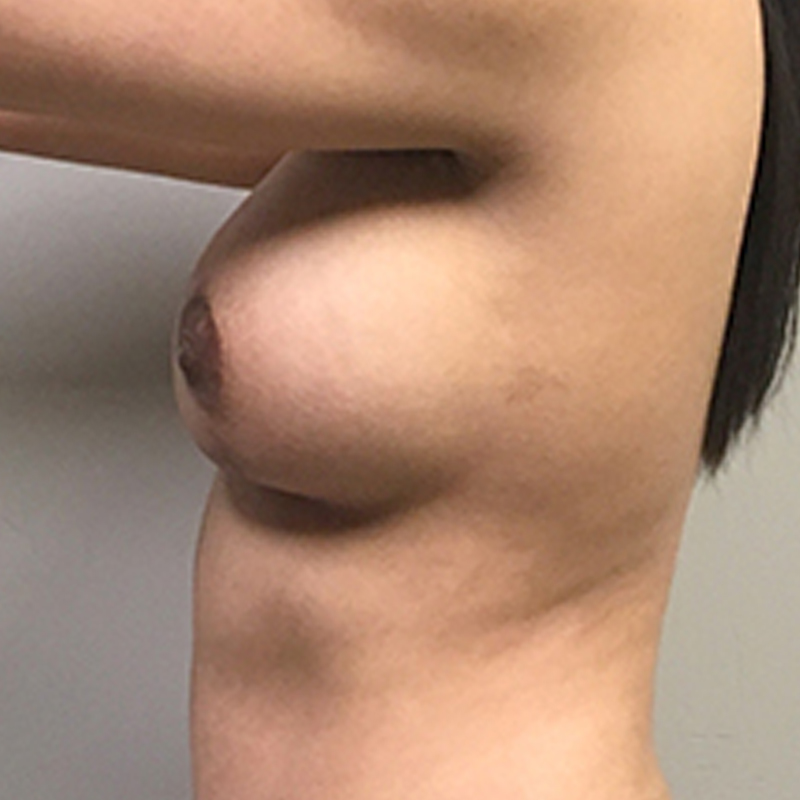 Breast Augmentation With Lift 05