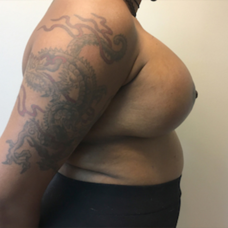 Breast Augmentation With Lift 05