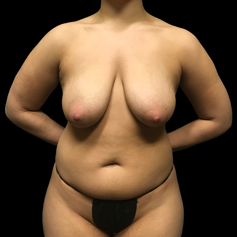 Breast Augmentation With Lift 01