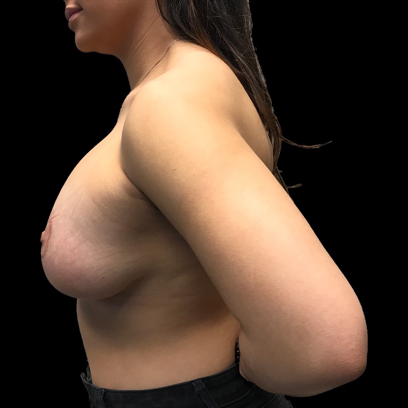 Breast Augmentation With Lift 05