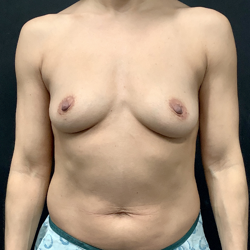 Breast Augmentation 01