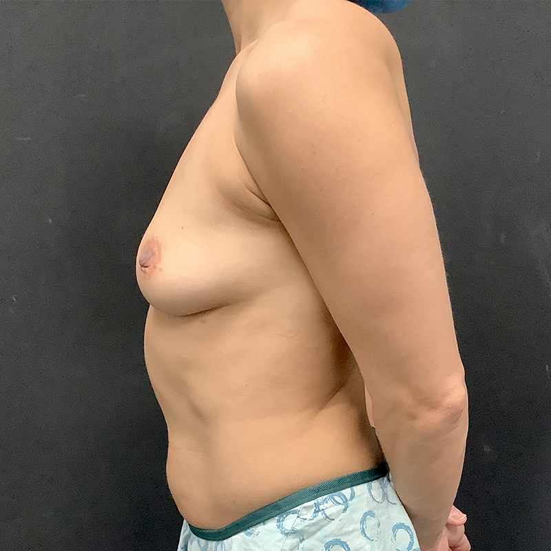 Breast Augmentation 03