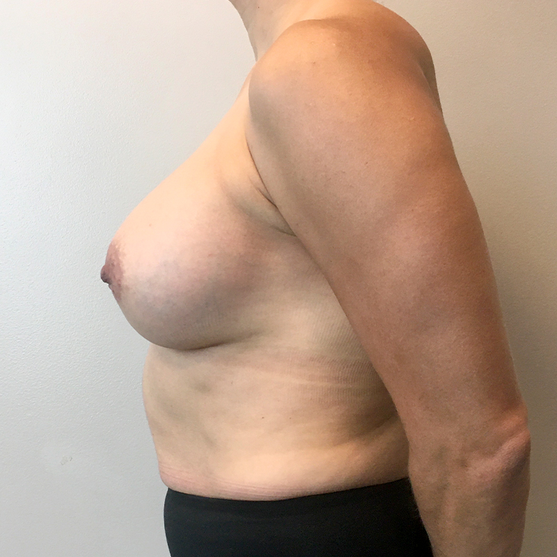 Breast Augmentation 03