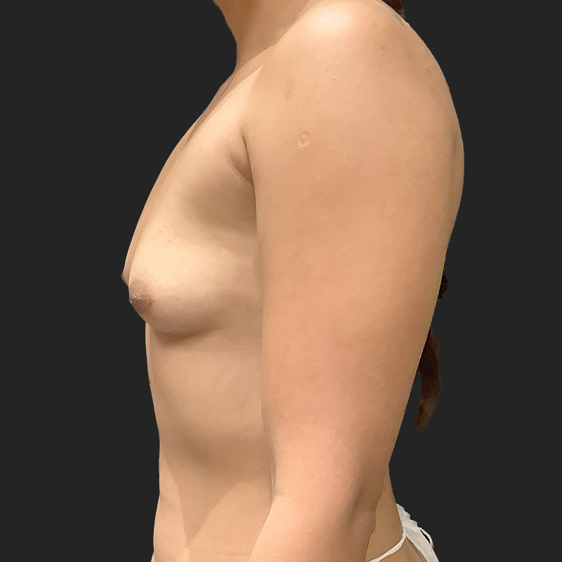 Breast Augmentation 05