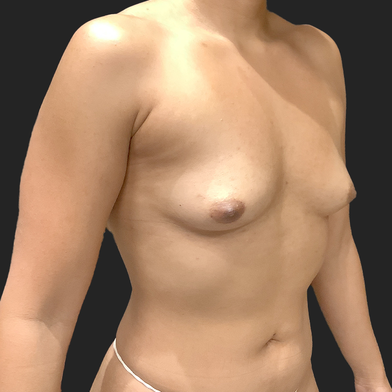 Breast Augmentation 07
