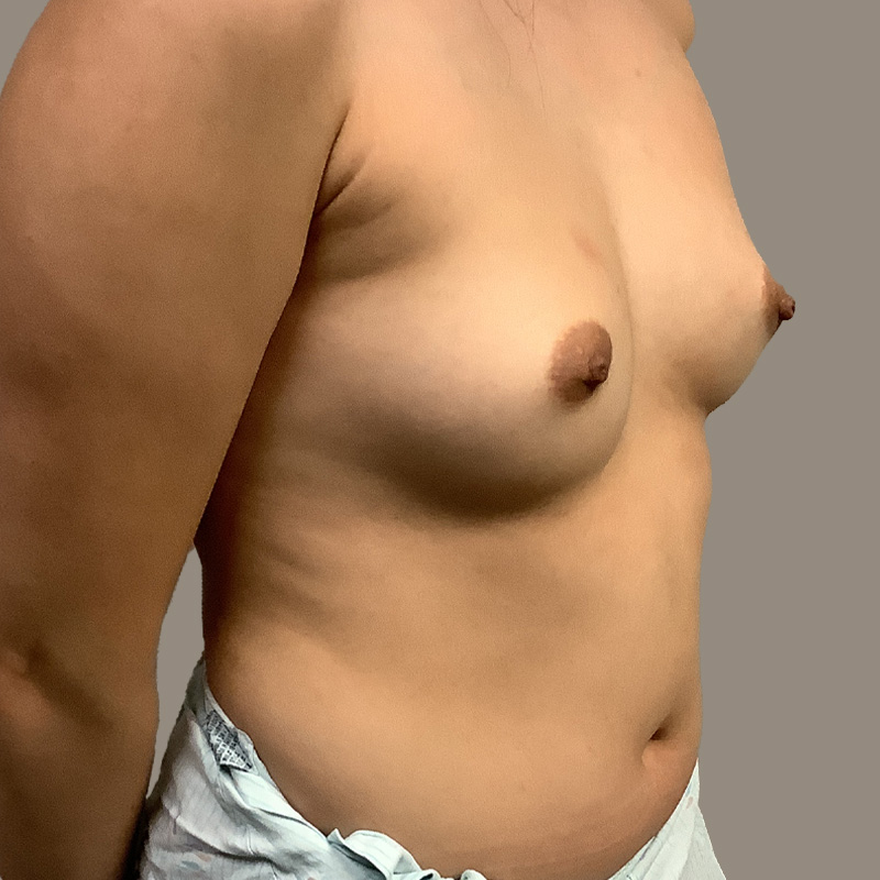 Breast Augmentation 05