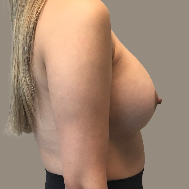 Breast Augmentation 09