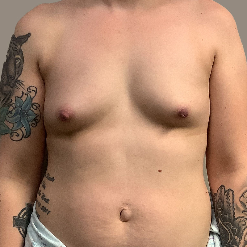Breast Augmentation 01