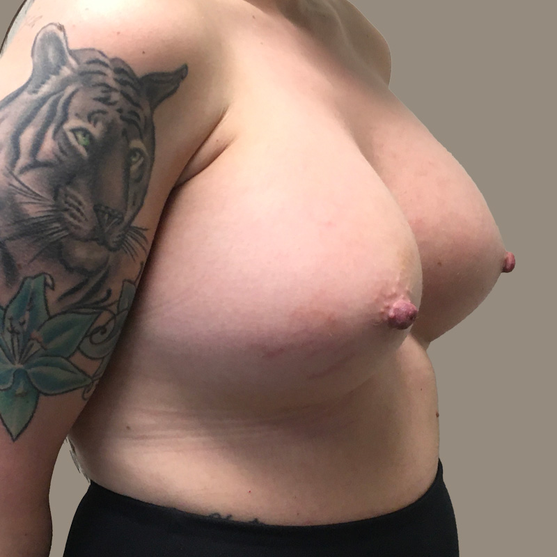 Breast Augmentation 05
