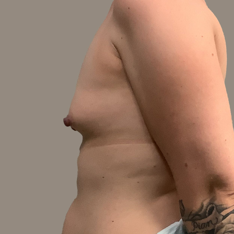 Breast Augmentation 09