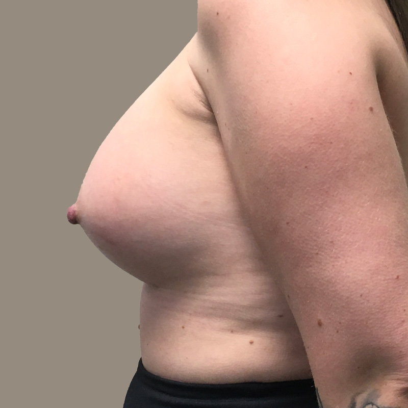 Breast Augmentation 09