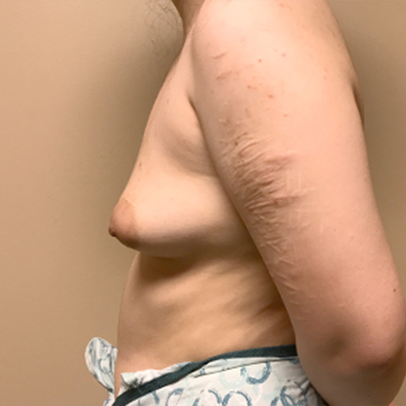 Breast Augmentation 05