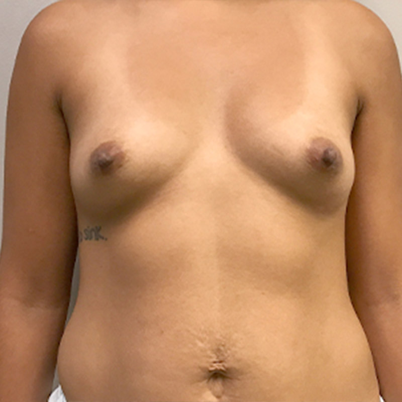 Breast Augmentation 01