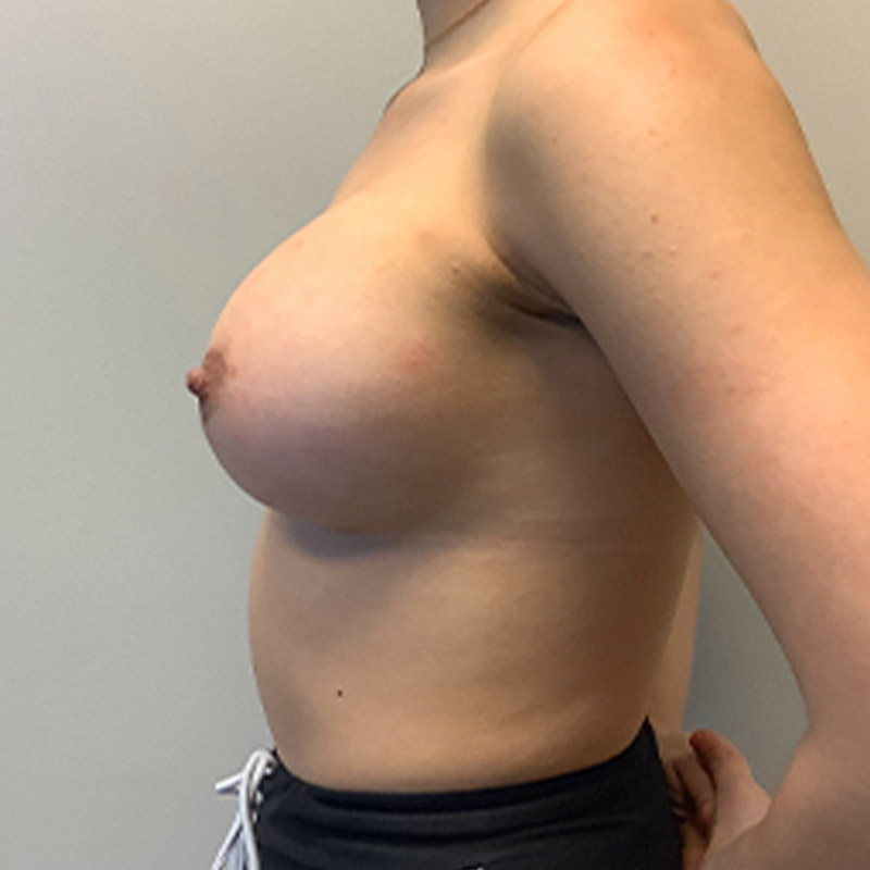 Breast Augmentation 05