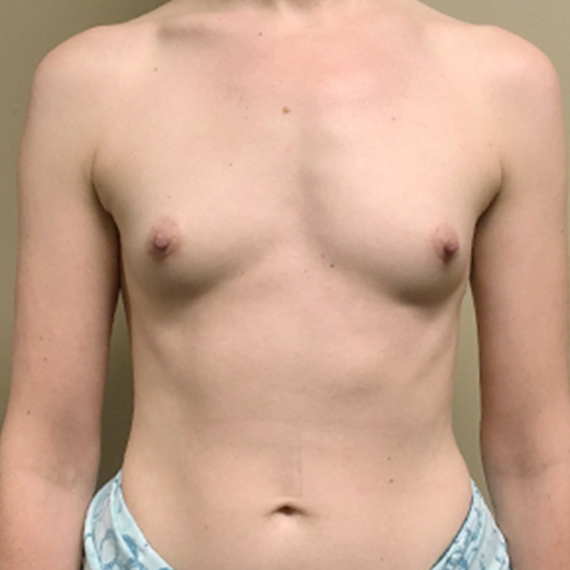 Breast Augmentation 01