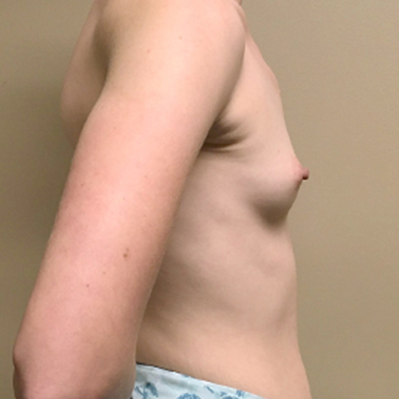 Breast Augmentation 09
