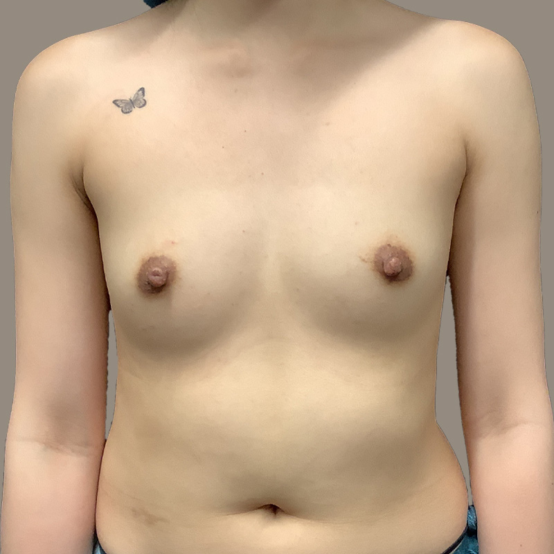 Breast Augmentation 01