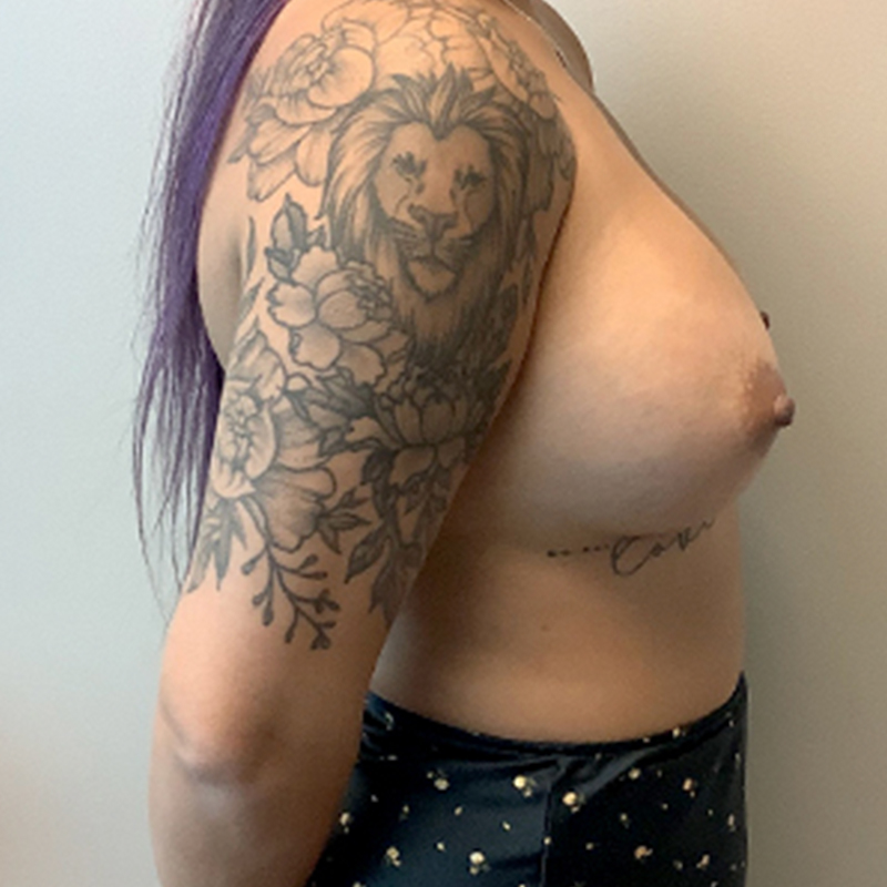 Breast Augmentation 09