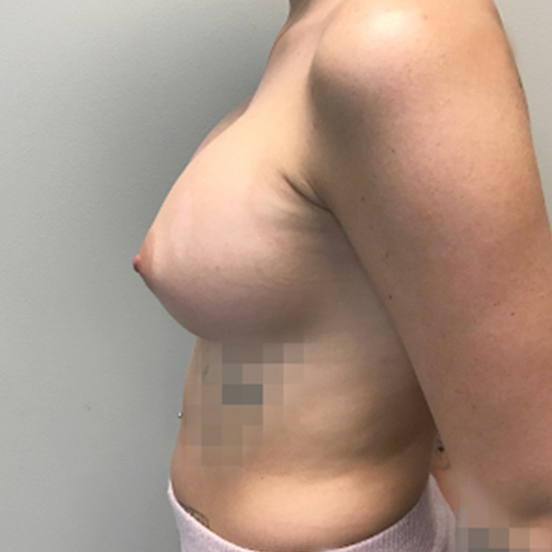 Breast Augmentation 05