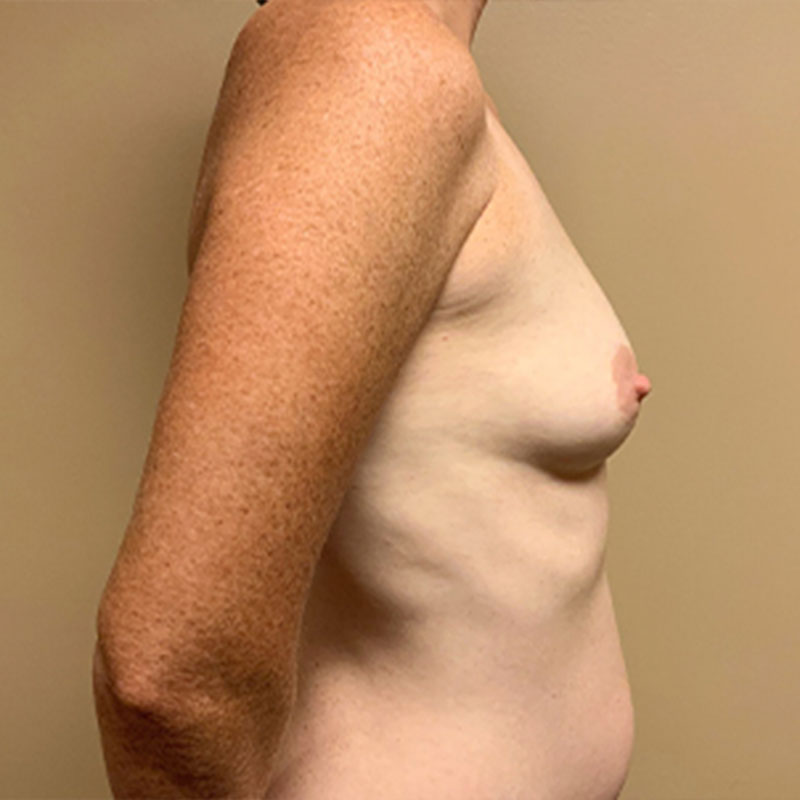 Breast Augmentation 09