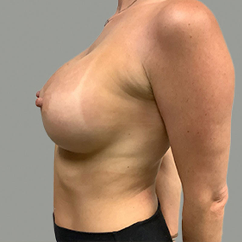 Breast Augmentation 05