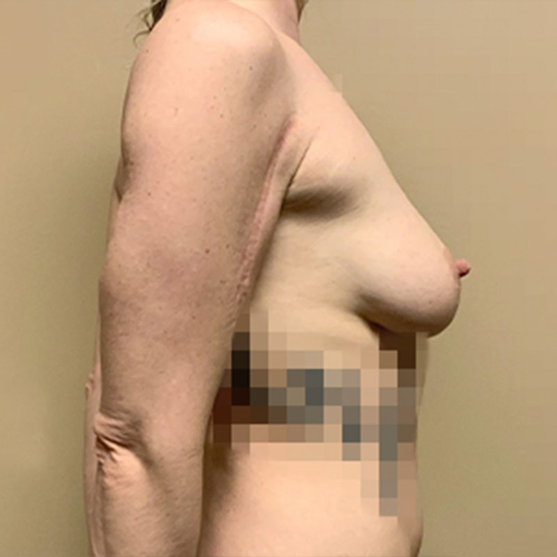 Breast Augmentation 09