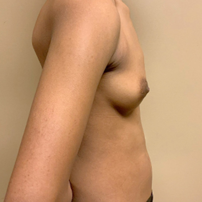 Breast Augmentation 03