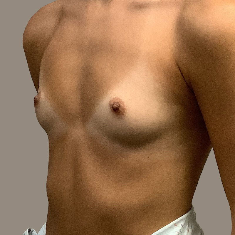 Breast Augmentation 09