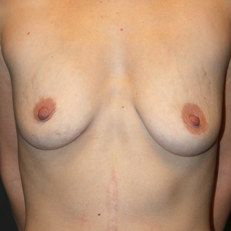 Breast Augmentation 01
