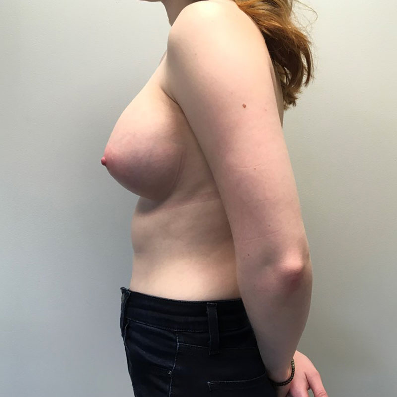 Breast Augmentation 07