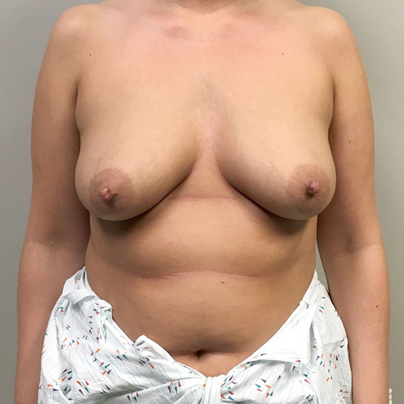 Breast Augmentation 01